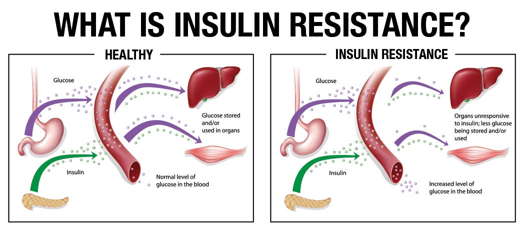 Insulin Resistance